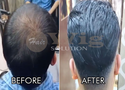 Hair Wig Shop in Delhi, Hair Patch For Men and Women